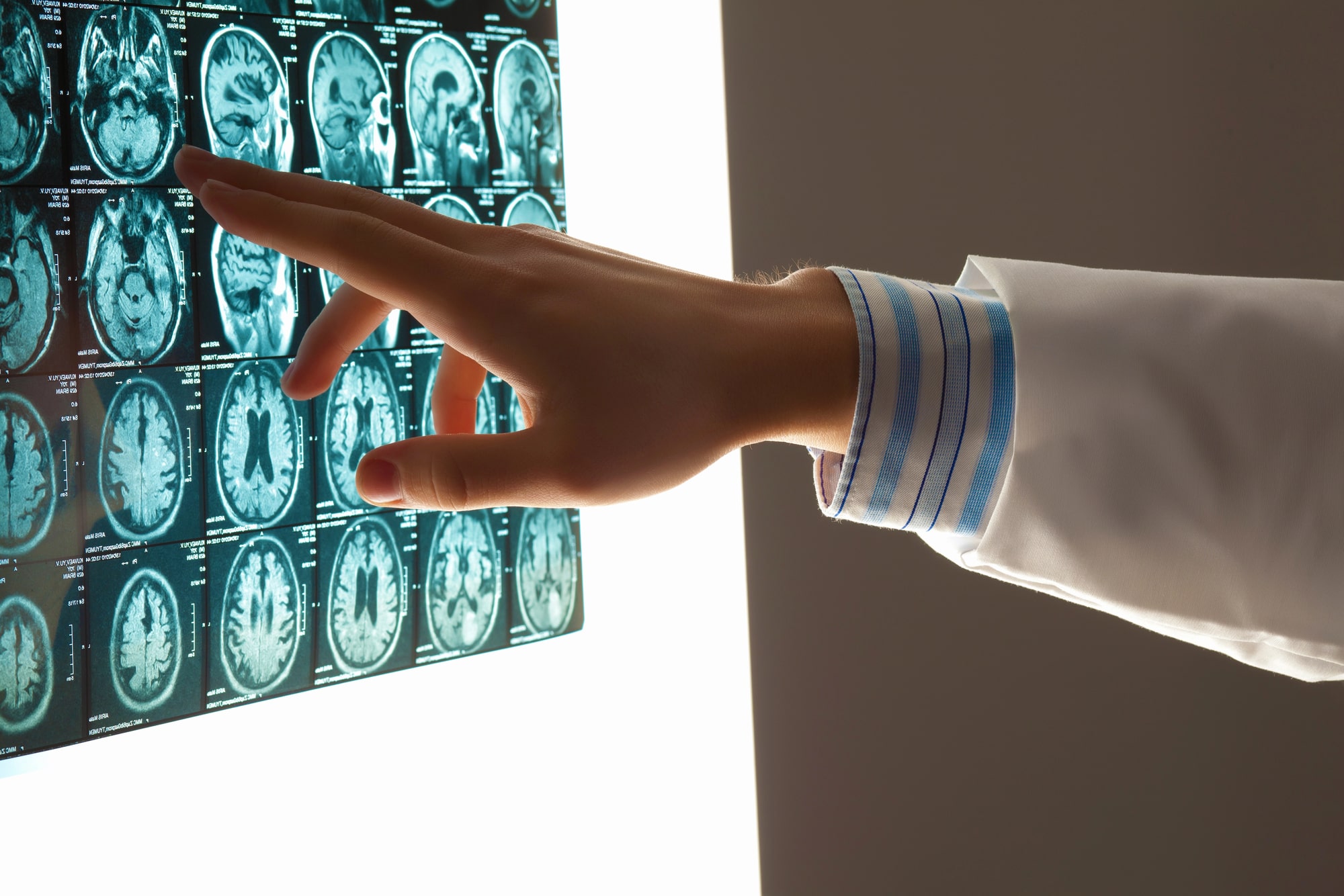 Brain Injuries Lawyer
